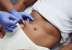 Is Mesotherapy on the Horizon? Is Mesotherapy on the Horizon?