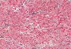 New Drug to Treat Advanced Soft Tissue Sarcomas Approved by the FDA New Drug to Treat Advanced Soft Tissue Sarcomas Approved by the FDA