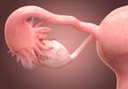 Ovarian Cancer Drug Granted Accelerated Approval by FDA Ovarian Cancer Drug Granted Accelerated Approval by FDA