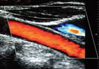 Health Care Setting Influences Treatment for Carotid Artery Stenosis Health Care Setting Influences Treatment for Carotid Artery Stenosis