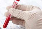 New Blood Test for Colon Cancer Improves Colonoscopy Screening Results New Blood Test for Colon Cancer Improves Colonoscopy Screening Results