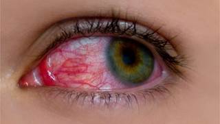 Glaucoma and Hypertension Glaucoma and Hypertension