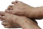 Penn Medicine Researchers Zero in on Psoriasis-Hypertension Link Penn Medicine Researchers Zero in on Psoriasis-Hypertension Link