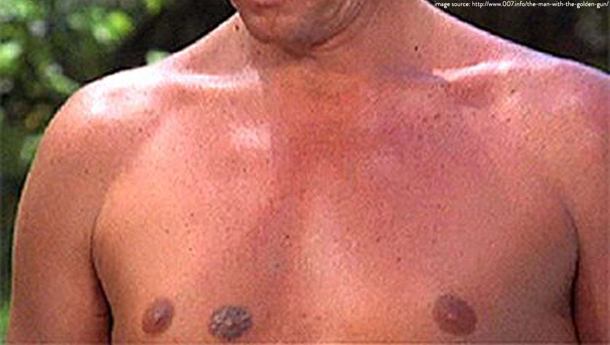 People With Extra Nipples 12