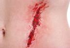 Forcing Wounds to Close Forcing Wounds to Close
