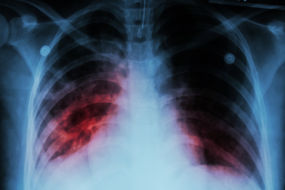 latent-tuberculosis-infection-screening-now-recommended-by-uspstf