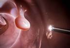 Routine Colonoscopy Performed After Age 75 Show Little to No Benefit, Study Finds Routine Colonoscopy Performed After Age 75 Show Little to No Benefit, Study Finds