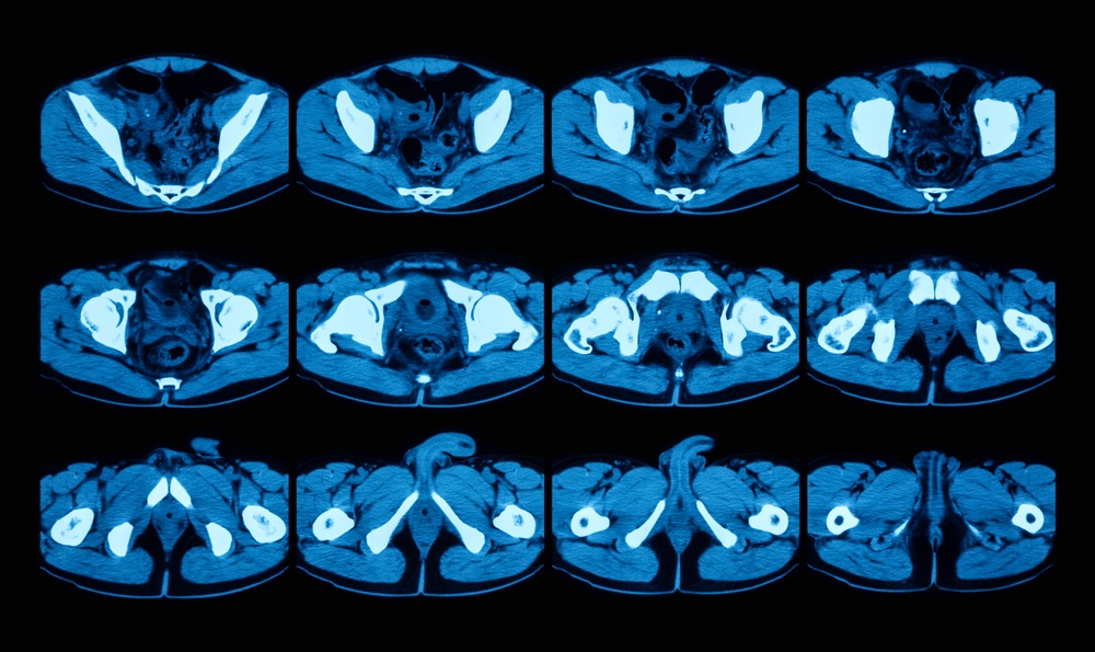 Routine CT Colonography May Be Useful in Detecting Abdominal Aortic ...