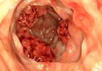 Mismatch Repair Deficiency Testing Low Among Young Adults With Colorectal Cancer Mismatch Repair Deficiency Testing Low Among Young Adults With Colorectal Cancer