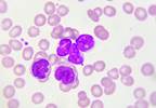 Significant Financial Burden Associated with Increase Costs of CLL Treatment Significant Financial Burden Associated with Increase Costs of CLL Treatment