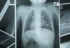 More Lung Cancer Screenings Needed for Smokers More Lung Cancer Screenings Needed for Smokers