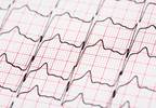 Rising Hospitalizations Seen for Atrial Fibrillation Rising Hospitalizations Seen for Atrial Fibrillation