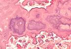 Coronary Artery Calcium Scores - A Marker for Early Adverse Events in Young Patients? Coronary Artery Calcium Scores - A Marker for Early Adverse Events in Young Patients?