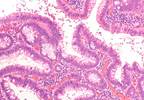 Colorectal Cancer Incidence Increasing Among Younger Americans Colorectal Cancer Incidence Increasing Among Younger Americans