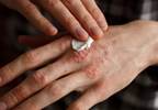 Significant Economic Burden Caused by Skin Diseases Significant Economic Burden Caused by Skin Diseases