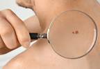 Guidelines Developed for Management of Certain Skin Cancers Guidelines Developed for Management of Certain Skin Cancers