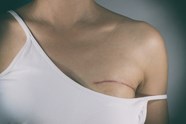 Nationwide Rates Of Contralateral Prophylactic Mastectomy Increases