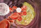 FOURIER Trial Reviewed: Are the Expensive PCSK9 Inhibitors Right for Your Patients? FOURIER Trial Reviewed: Are the Expensive PCSK9 Inhibitors Right for Your Patients?