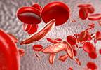 Endari Approved by FDA to Treat Sickle Cell Disease Endari Approved by FDA to Treat Sickle Cell Disease