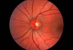 Artificial Intelligence Detects Diabetic Retinopathy With High Specificity Artificial Intelligence Detects Diabetic Retinopathy With High Specificity
