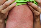 Analysis of Reasons Behind Continued Measles Outbreaks in US Analysis of Reasons Behind Continued Measles Outbreaks in US