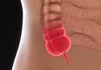 Patient Preference of Surgery vs Antibiotics for Acute Appendicitis Patient Preference of Surgery vs Antibiotics for Acute Appendicitis