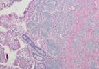FDA: Lutathera Approved to Treat Gastroenteropancreatic Neuroendocrine Tumors FDA: Lutathera Approved to Treat Gastroenteropancreatic Neuroendocrine Tumors