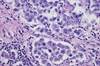 USPSTF: Updated Ovarian Cancer Screening Recommendations USPSTF: Updated Ovarian Cancer Screening Recommendations