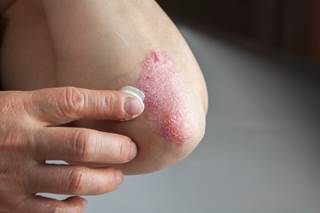 Nearly nearly 50% of patients with psoriasis are not appropriately screened or treated for depression,